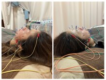 仁接骨院 じん鍼灸治療院の雰囲気（美容鍼灸で真皮を刺激し肌質を改善、身体の内側からキレイに）