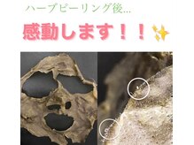 美肌脱毛専門店 パールプラス 大在店/ハーブの抜け殻
