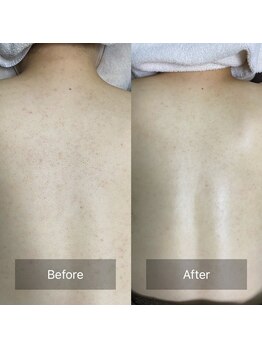エクラルム(Eclaleum)/BeforeAfter　背中ピーリング