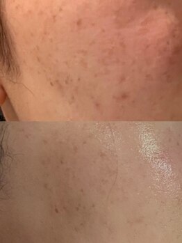 ユウビビューティサロン 東生駒(Yuubi Beauty Salon)/【peel stage】ハーブピーリング