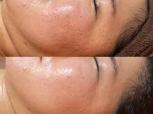 ビジュープラス 広島店(Bijou+)/【30代/凹凸肌、赤み】