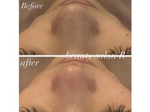 ビューティサロン アール(R)/お鼻毛穴も１回の施術でちゅるん