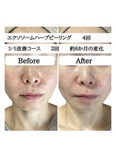 ル ボヌール 伊那店(le bonheur)/ダウンタイムなし！剥離ナシ！