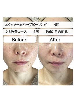 ル ボヌール 伊那店(le bonheur)/ダウンタイムなし！剥離ナシ！