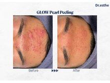 オーシャンブルー 福岡店(OCEAN BLUE フェイシャル&ボディ)/【韓国】グロウパールピーリング