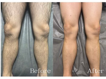 シルビー(CILBE)/脚MIX脱毛