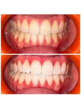 コナホワイトニング 神保町/初回ホワイトニング