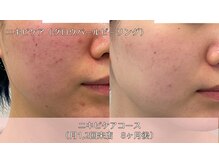 オーシャンブルー 時津店(OCEAN BLUE)/ニキビケア(グロウパールピール)