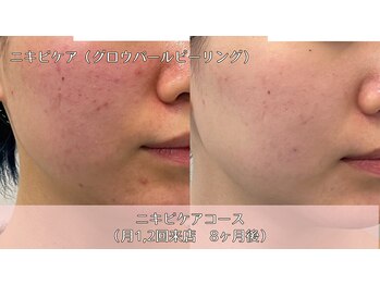 オーシャンブルー 時津店(OCEAN BLUE)/ニキビケア(グロウパールピール)