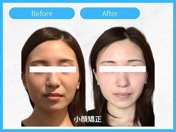 トウメイコガオ 横浜店/トウメイコガオで小顔エステ