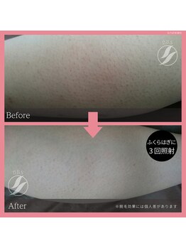 ブロンズ(BRONZE)/ふくらはぎ