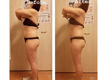 リリウム(Lilium)/筋膜リリース｜Before After