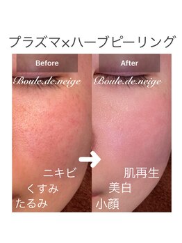 ブールドネージュ(Boule de Neige)/最強艶肌漢方ハーブ×プラズマ