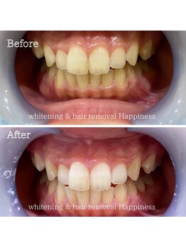 ハピネス 心斎橋アメリカ村本店(Happiness)/はじめてのホワイトニング