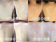 エヌエースキン 北谷店(NAskin)の雰囲気（ハーブピーリング/背中ニキビケア/トラブル改善/シミ改善）
