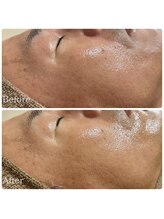 エース(ACE.)/天然ハーブの力で新陳代謝UP☆