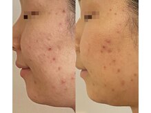 ラスティック(rustique)/肌悩みのある方でも受けられます