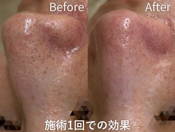 セレソル(CERESOL)/私の魔法の毛穴洗浄術