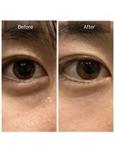 ピンクッション 平尾(PINKSHION)&nbsp;目のたるみ ケア