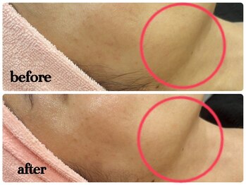 シルク(Cilk)/ハリ、ツヤ、リフトアップ◎