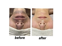 ビカム(become)/髭脱毛