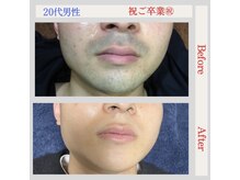 トータルケアーサロン アクア 時津(AQUA)/脱毛：ビフォーアフター１