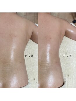 エン ボディアンドフェイシャル(En)/ハイパーシェイプ/背中・肩甲骨