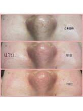 ユニ(uni.)/毛穴エクストラクション症例