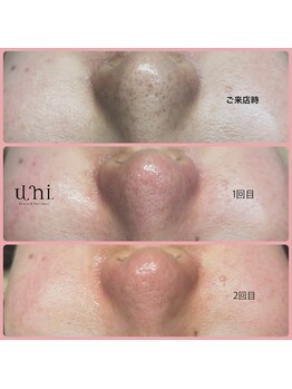 ユニ(uni.)/毛穴エクストラクション症例