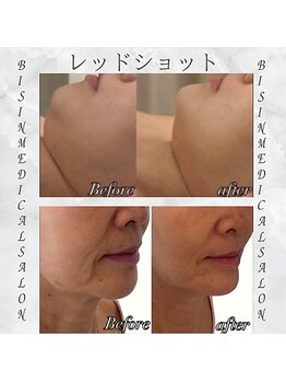メディカルエステ 新宿店/※レッドショット症例※