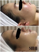 ビズビズ 天王寺店(bisebise)/ニキビ/毛穴開き黒ずみ角栓詰り