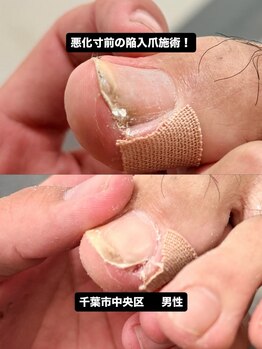 巻き爪じゅん 船橋店/悪化する前に対応した陥入爪