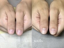 アーティネイルズ(Aaty Nails)/【深爪矯正】ハンド