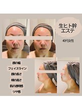 モーイエンチャーム(mooi en charme)/フェイシャル×生ヒト幹50％導入