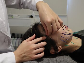 ビーロイヤル(B-ROYAL)/フェイシャル美容鍼リフトアップ