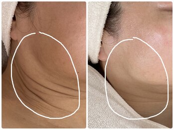 ノーブル シャット Noble Chate/続!小顔コースではないけれど