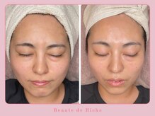 ボーテドリッシュ(Beaute de Riche)/Vフェイスラインへ導く