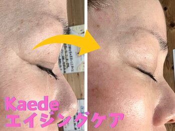 柏ベルミーランド/しわ・たるみへアプローチ!!