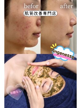 肌質改善専門店　アンジュネス　エステティックサロンの写真/池袋駅1分[もうコンシーラーを使いたくない！すっぴん美肌になりたい方へ]91.8%が改善をご実感！当日化粧OK
