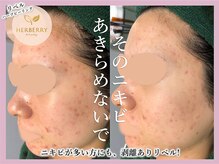 アッシュ 梅田(H)/ハーブピーリング専門Hアッシュ