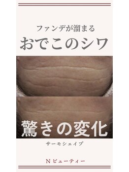 Nビューティー/最新RFサーモシェイプオーパス