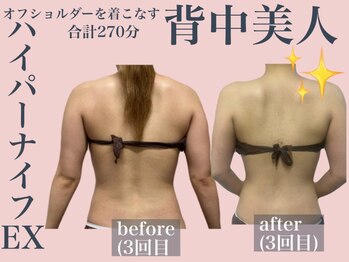 エステサロン ヴリエ 立川店/ハイパーナイフEX計270分施術★