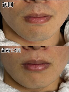 ルシャトン(Le Chaton)/ヒゲ脱毛