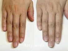 アーティネイルズ(Aaty Nails)/【深爪矯正】ハンド