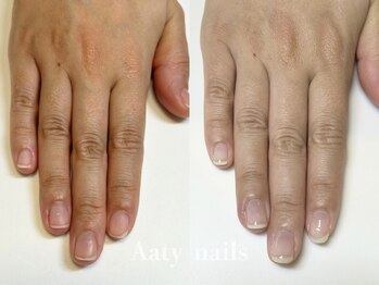 【深爪矯正】ハンド