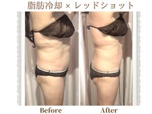 モテスリム/脂肪冷却×レッドショット