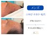 【メンズ】ニキビ・テカリ・毛穴のお悩みに|REVIハーブピーリング