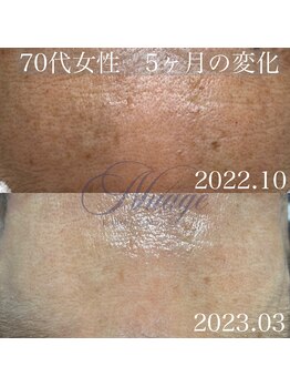 ニュアージュ(Nuage)/70代女性 5ヶ月の変化