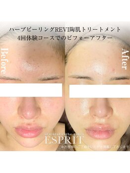 エスプリ 銀座店/ハーブピーリング銀座