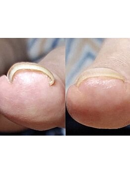 爪の悩みを解消できる（ケア含む）